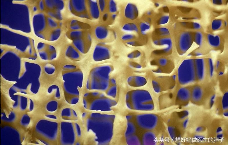 骨质疏松症与重度骨质疏松的区别,请问专家骨质疏松怎么治疗