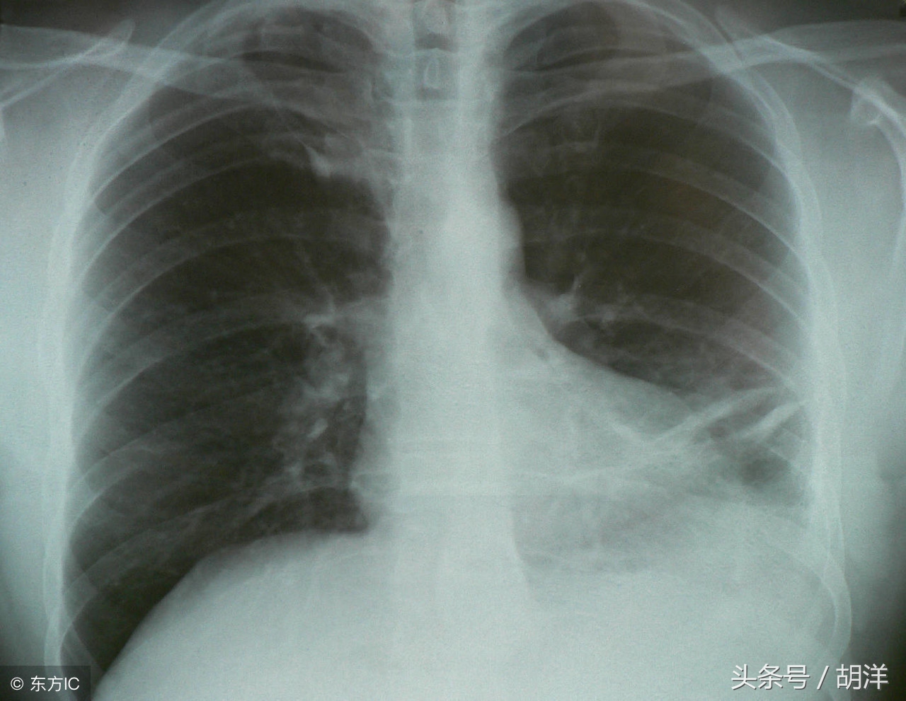 肺癌晚期是不是没希望了？医生：如果是这1种，基本100%治愈