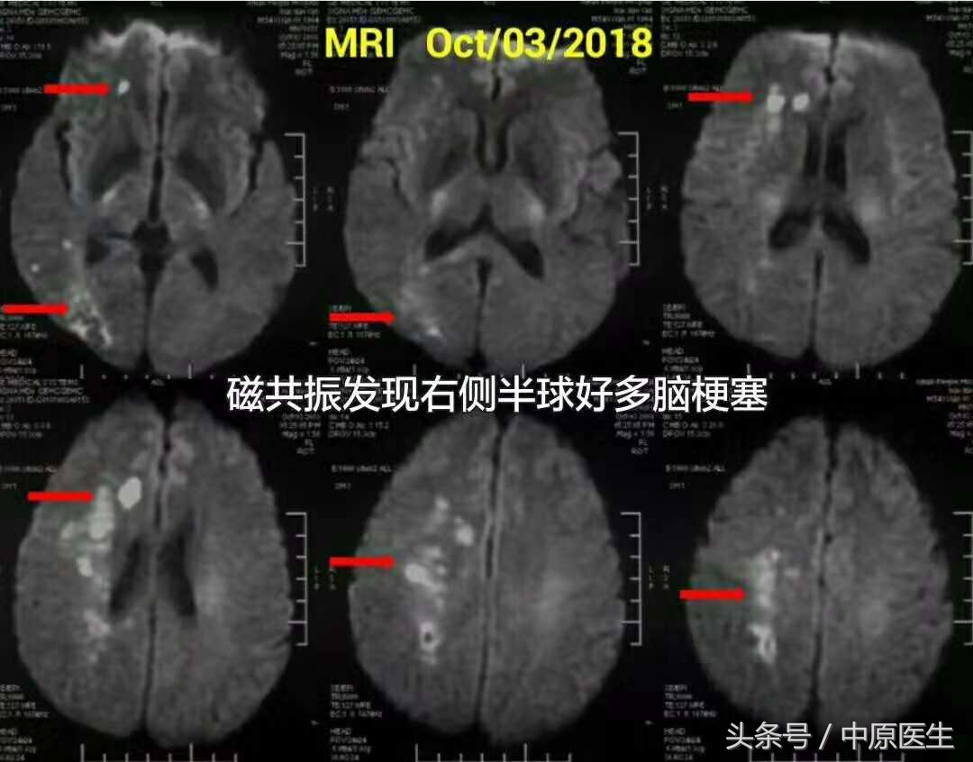 53岁男子脑梗急救室抢救真实纪实,脑动脉闭塞介入治疗视频