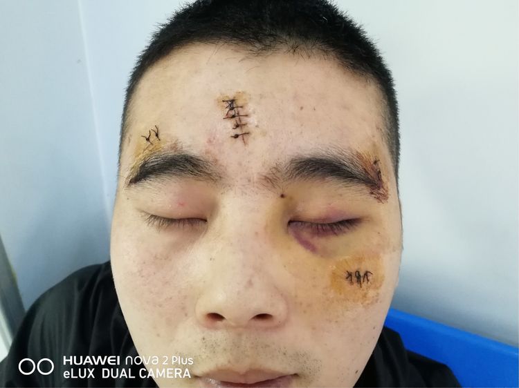 面部外伤后初期疤痕凸起怎么修复,面部外伤凹陷疤痕怎么去除