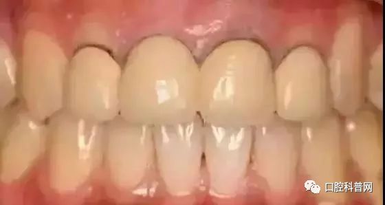 全瓷牙和烤瓷牙的区别到底在哪,上海烤瓷牙和全瓷牙费用相差多少