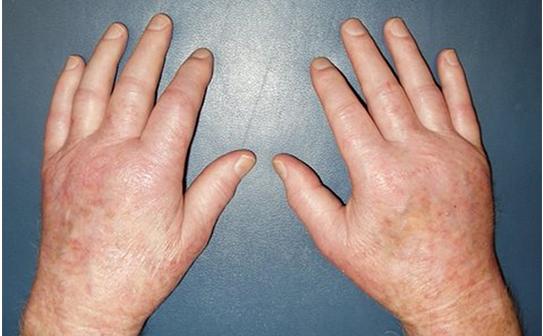 肌肉恶性肿瘤的症状有哪些,恶性骨肿瘤开始的症状