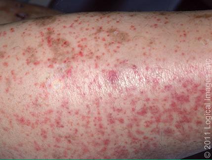 肌肉恶性肿瘤的症状有哪些,恶性骨肿瘤开始的症状