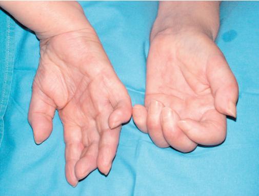 肌肉恶性肿瘤的症状有哪些,恶性骨肿瘤开始的症状