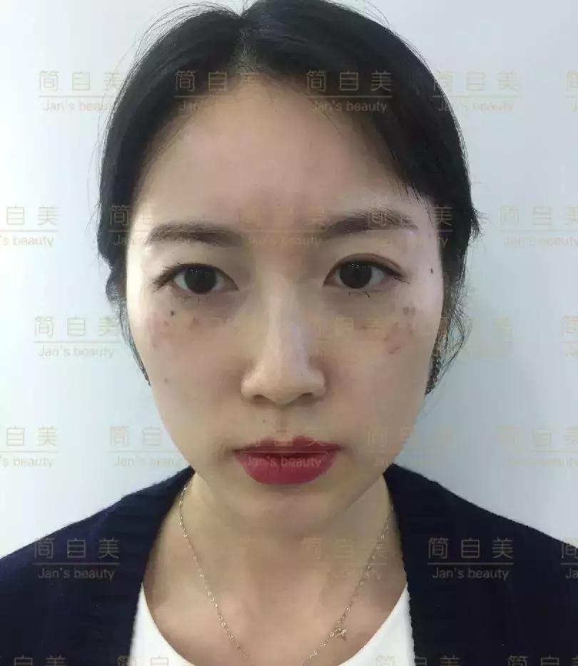 祛斑变美的过程,简美人祛斑祛黄褐斑