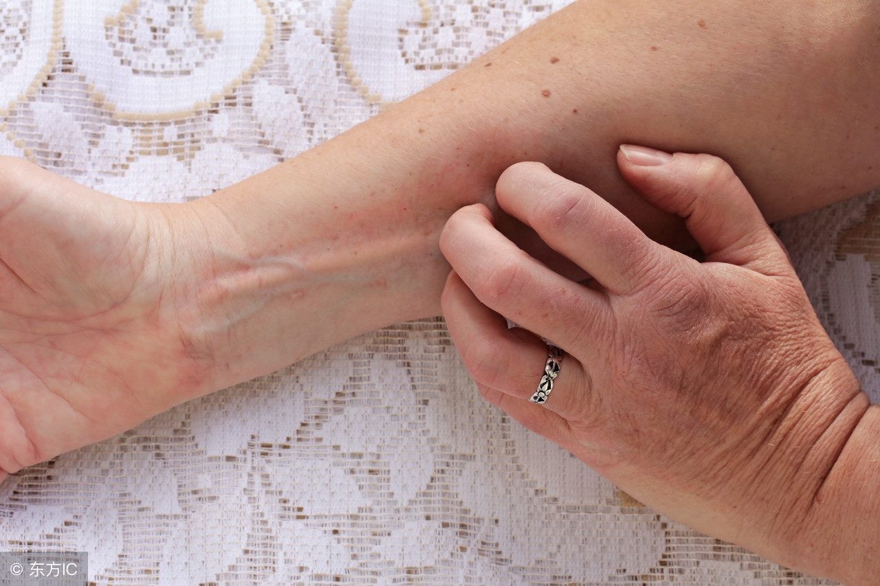 艾灸哪个穴位治疗湿疹最有效,耳朵里有湿疹可以按哪些穴位