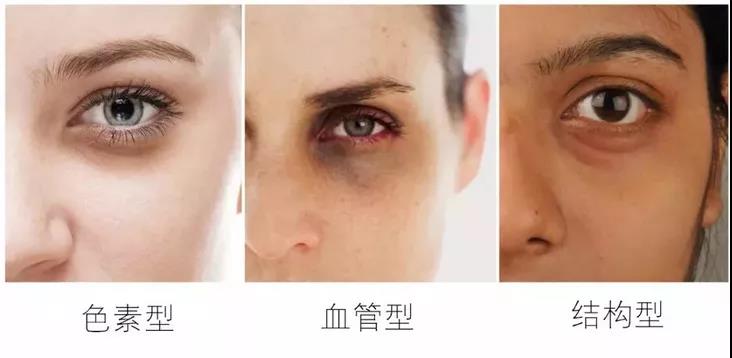 眼袋眼纹黑眼圈改善方法,去黑眼圈眼袋眼纹最有效的小妙招