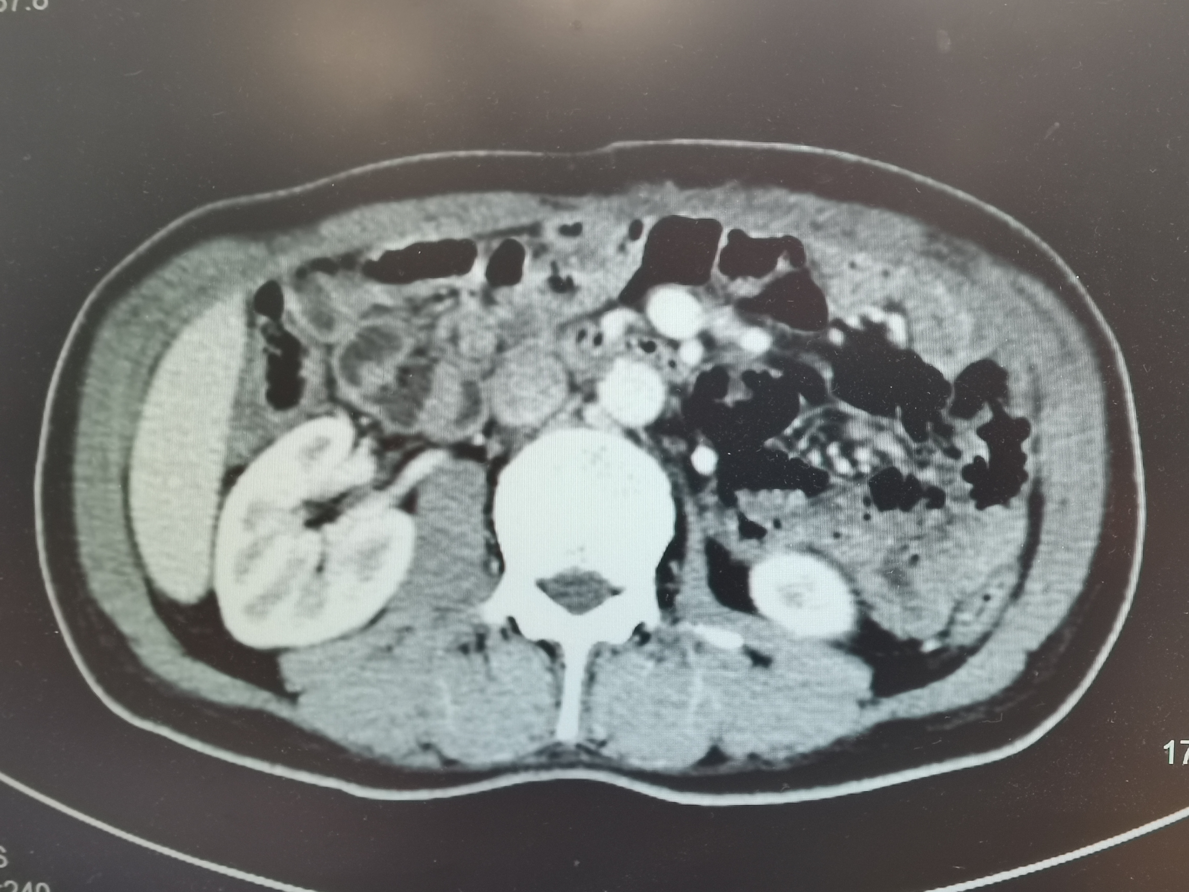 胃间质瘤23例,和胃间质瘤对抗的12年