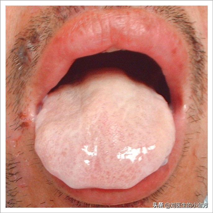 舌象图解大全中医舌诊,最全中医舌诊图谱来了