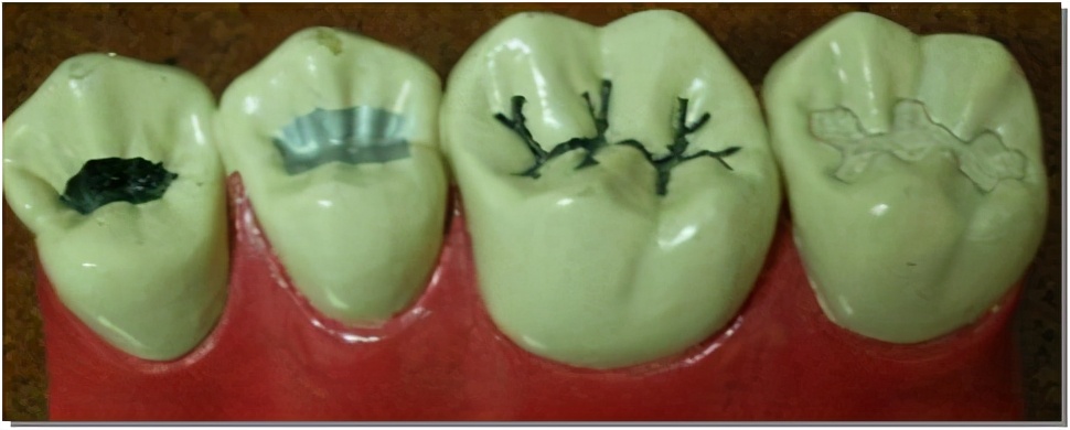 儿童换牙期常见牙齿问题,小朋友换牙新牙已出旧牙没松咋办