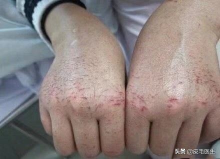 频繁使用洗手液皮肤皲裂怎么办,手皲裂湿疹用什么洗