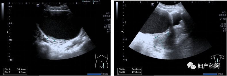 轻微子宫内膜异位症病历单,病理报告子宫内膜异位囊肿