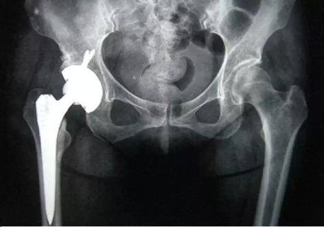 老年人骨质疏松严重造成腰骨折,髋部骨折包括哪些骨折