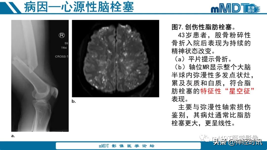 急性缺血性脑卒中ppt素材图片,青年缺血性脑卒中ppt