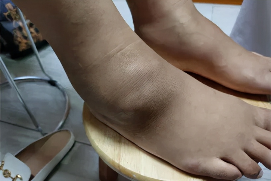 别让痛风伤害你的肾，治疗痛风不拖延，融晶，保肾，调代谢