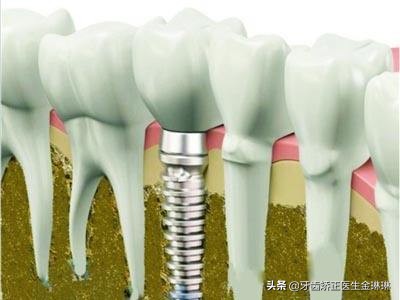 大牙没了怎么办,大牙没了用什么方法弥补