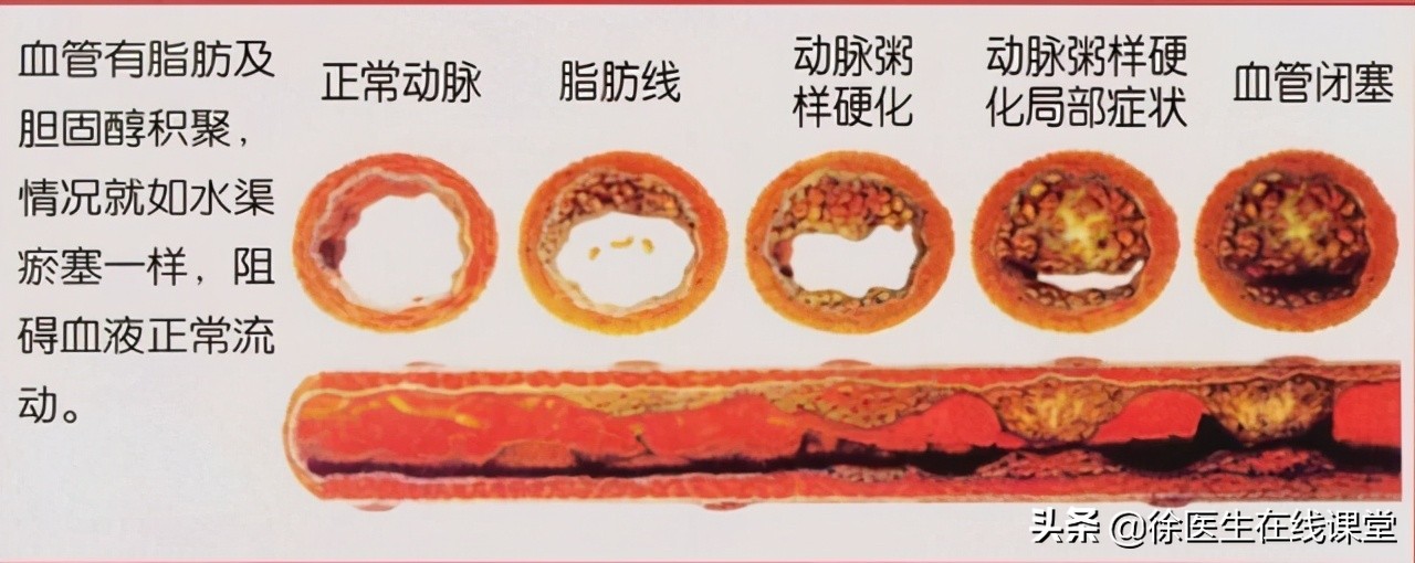 肝硬化消化道出血静脉曲张的治疗,肝硬化静脉曲张出血治疗原则