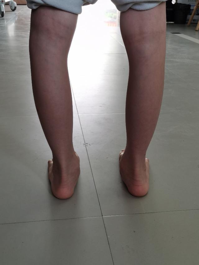 什么是足外翻？需要治疗吗？