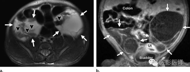 孕早期卵巢囊肿边界清形态规则,孕期卵巢囊肿呈液性伴点状回声