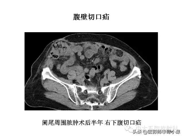 阑尾炎课件,阑尾炎的超声课件