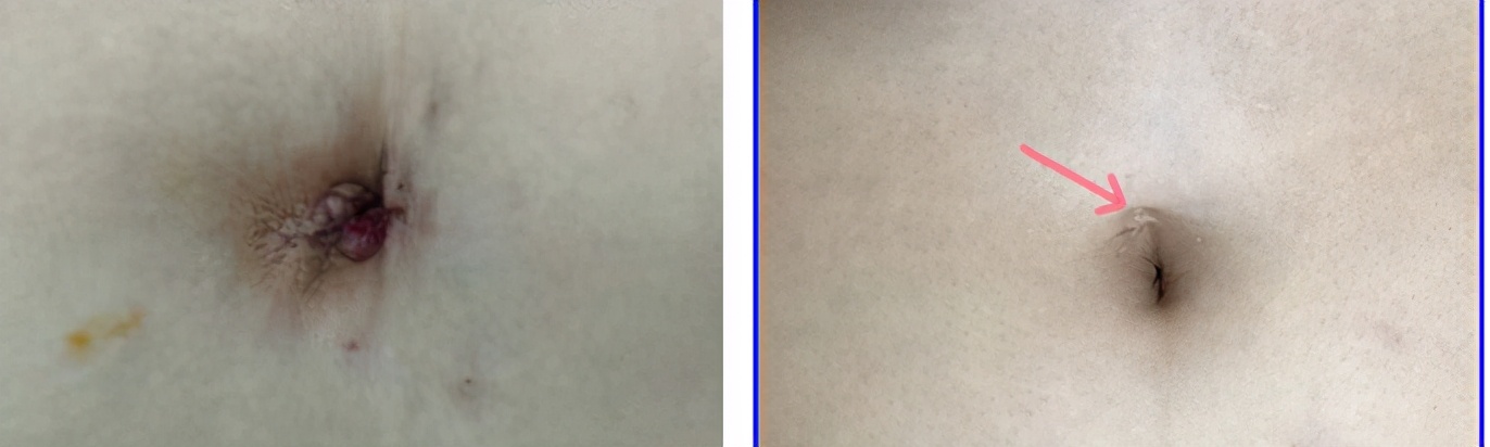 单孔微创腹腔镜,单孔腹腔镜手术让你美丽无忧虑