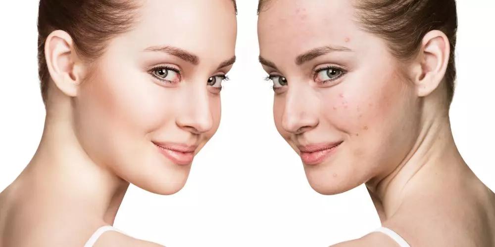 油痘肌平价洁面推荐,推荐油皮泡泡洗面奶