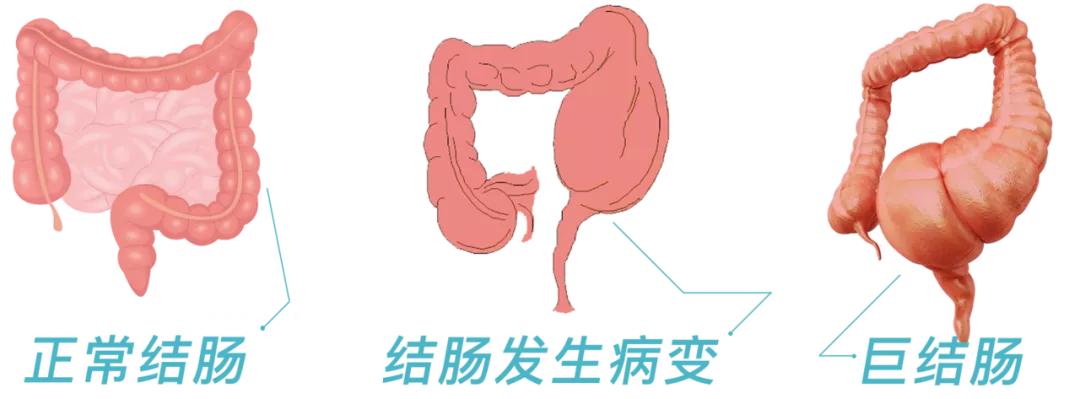 医学科普便秘,医生科普便秘吃这些药当心毁肠子