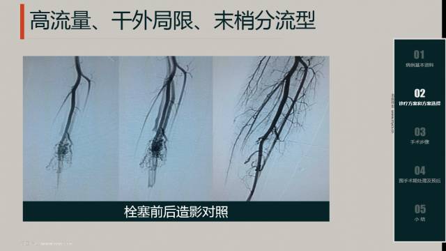 左侧颞窝动静脉畸形介入栓塞术,动静脉畸形介入栓塞后偏瘫