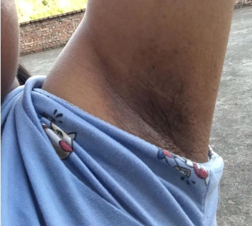 腋臭治疗篇,腋臭治疗合集