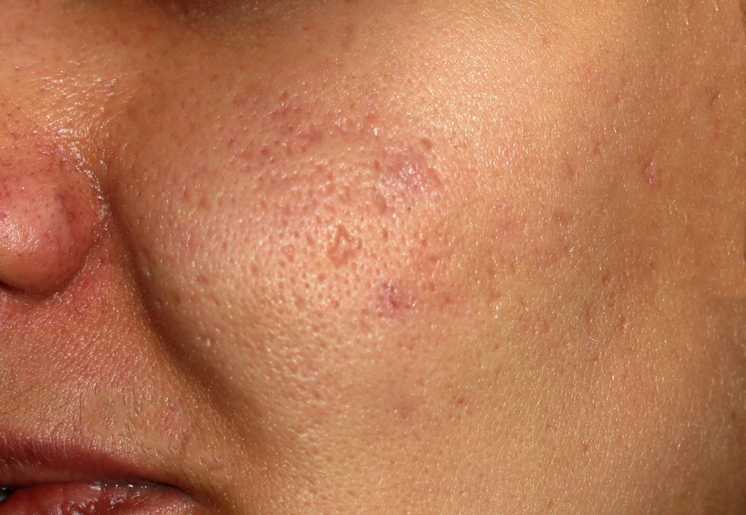 皮肤美容激光术后护理｜科普篇