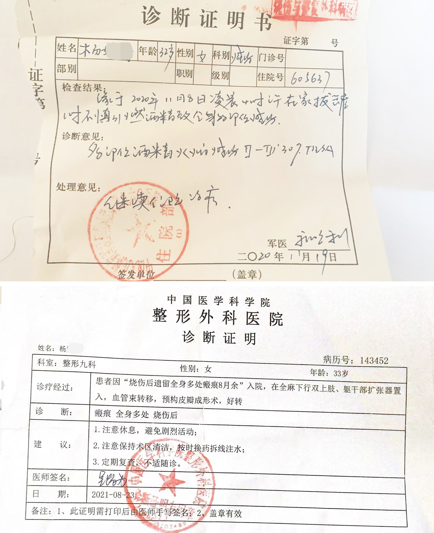 美女辣妈拔火罐烧伤如戴紧箍咒,美妈凌晨拔火罐烧伤