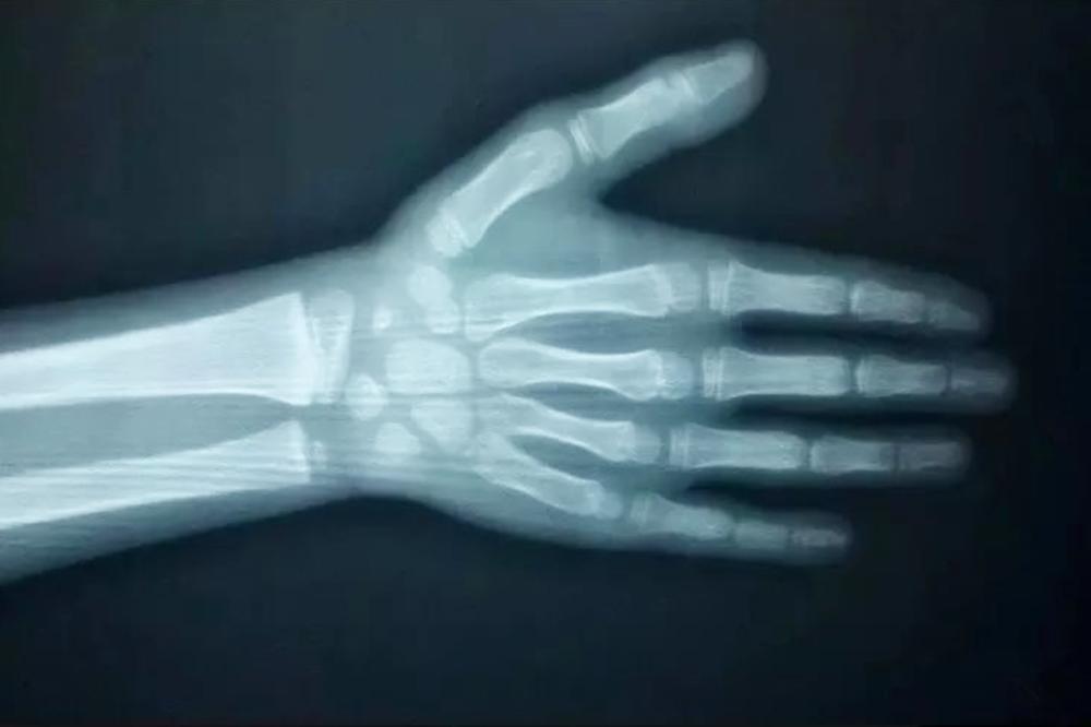 长高科普延缓骨龄增长的饮食建议,骨龄已经闭合了孩子怎样才能长高