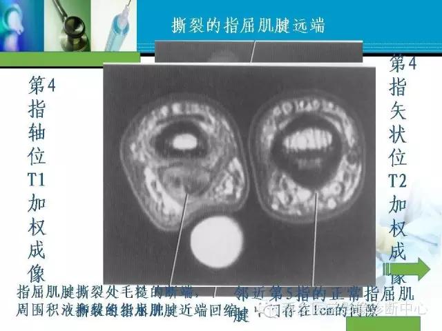 单只手指磁共振,手指用磁共振能做出来结果吗