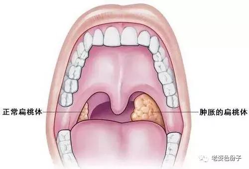 鱼刺卡喉怎么办,鱼刺卡喉怎么办教你一个化骨大法