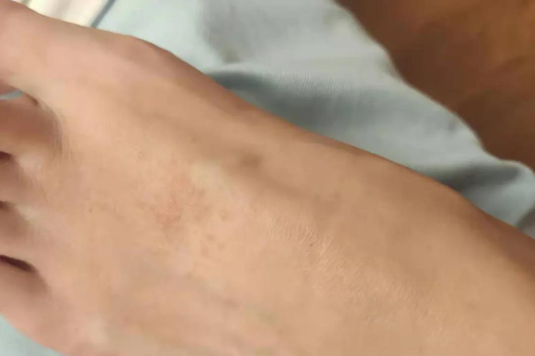 一坨痒痒的小疙瘩,咯吱窝一片一片的红疙瘩很痒