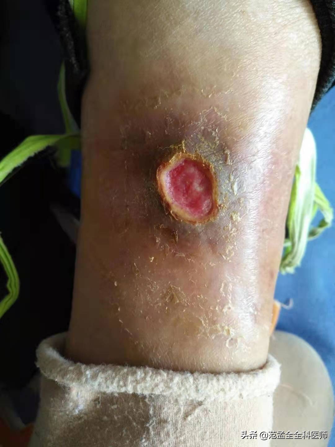 老年痴呆褥疮的护理和治疗,褥疮的护理建议和治疗方法推荐