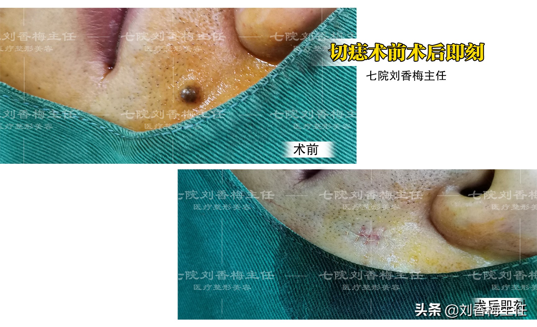 黑痣要弄掉看什么科,黑痣去除是看外科还是皮肤科