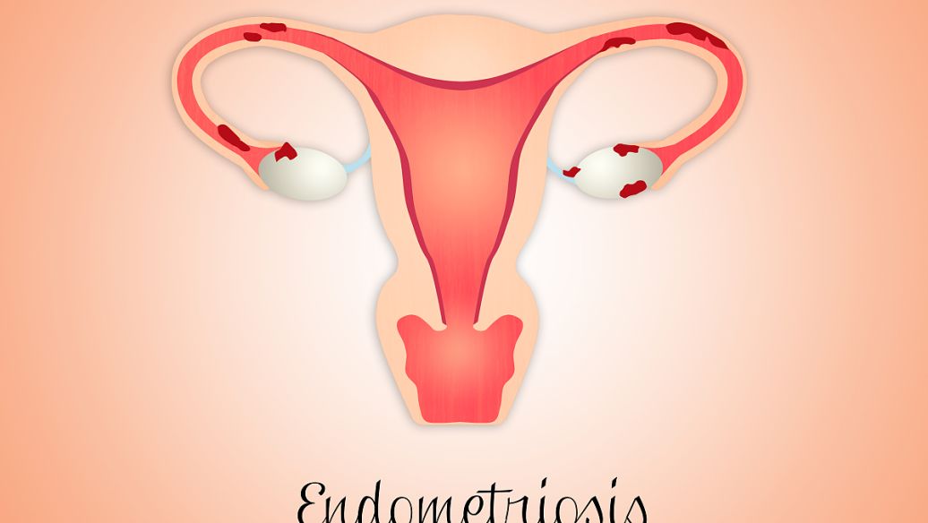 多囊卵巢综合症中医治疗案例,多囊卵巢综合症一年无措施没怀上