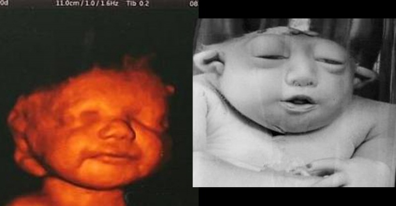 服用孕妇禁用药后发现怀孕了,孩子能不能留,会有什么影响?