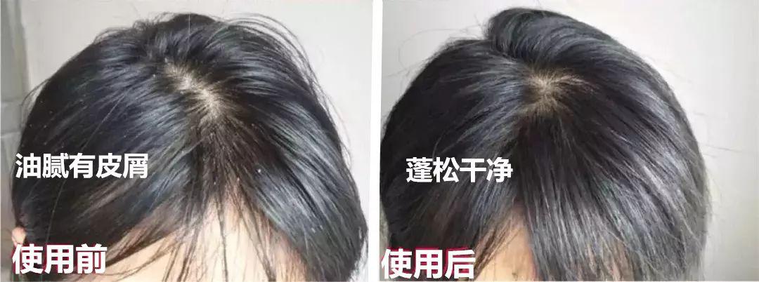 去头屑去螨虫哪个洗发水最有效,去头屑去螨虫用哪个洗发水最有效