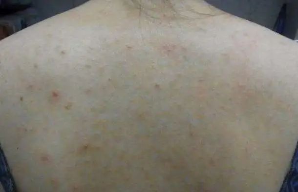 美背长痘,后背长痘的美背方法