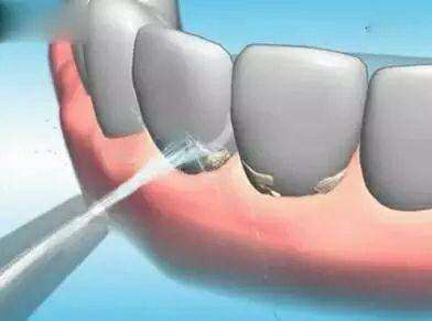 牙龈萎缩黑三角塞牙,牙齿黑三角如何让牙龈长出来