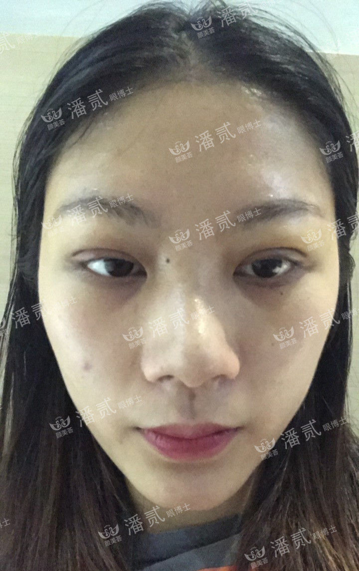 肿眼泡抽脂肪埋线双眼皮效果,肿眼泡割双眼皮长脂肪