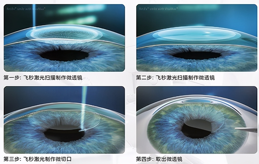 做半飞秒近视眼手术最坏的后果,近视眼手术最佳年龄和度数费用