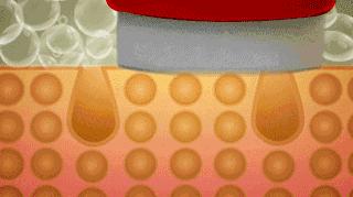 为了变美到底该不该打玻尿酸,玻尿酸注射后变丑了怎么办