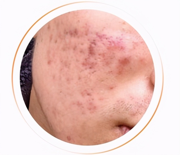 祛除痘坑痘印药膏,男士痘印痘坑怎么去除