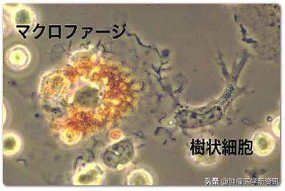 日本发明抗癌药免疫疗法,日本最新免疫治疗癌细胞