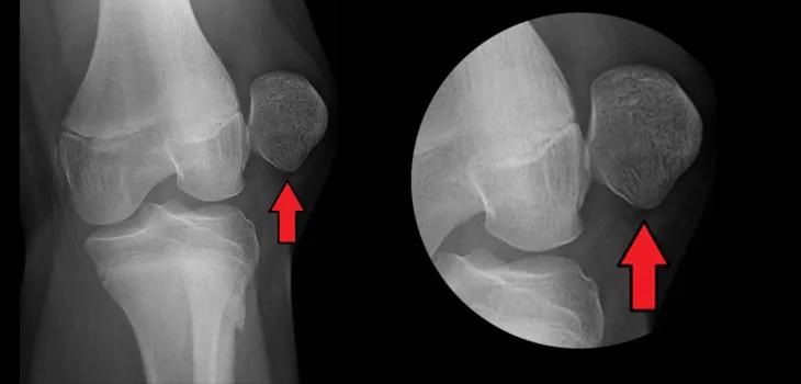 狗狗髌骨半脱位治疗最佳办法,狗狗的髌骨脱位就一定要做手术吗