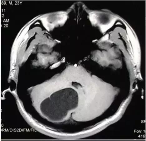 各种囊肿的症状,颅内囊肿18-19mm严重吗