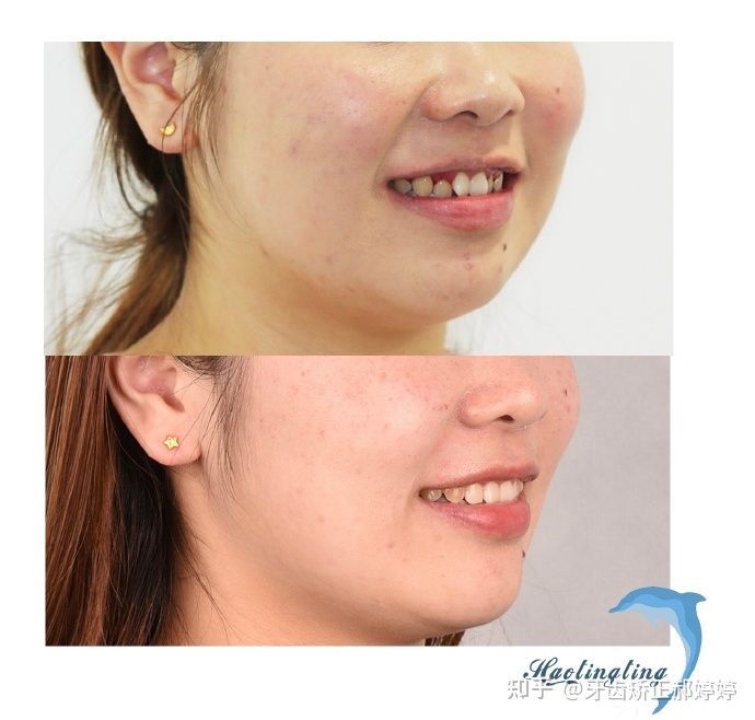 上海成人牙齿矫正失败案例,上海牙齿矫正郝婷婷医生